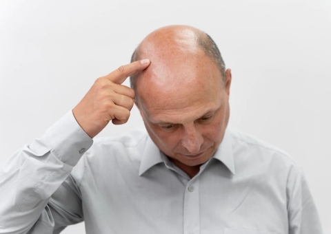 Estudo revela que beber refrigerante pode aumentar em 57% o risco de calvície em homens 