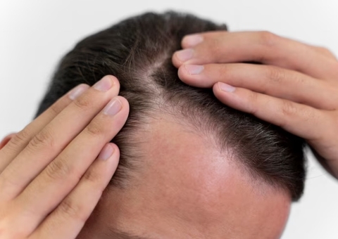 Uso de boné ou consumo de refrigerante? Descubra mitos e verdades sobre a calvície