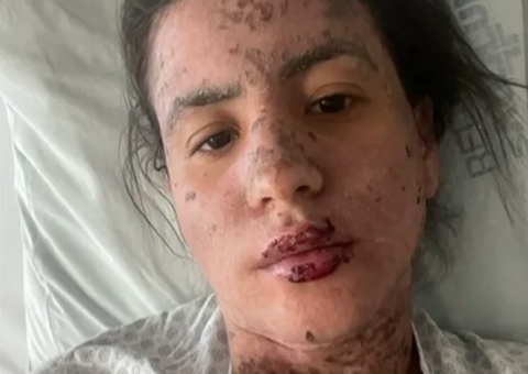 Síndrome de Stevens-Jhonson: Conheça doença rara que deixou mulher de Frank Aguiar na UTI