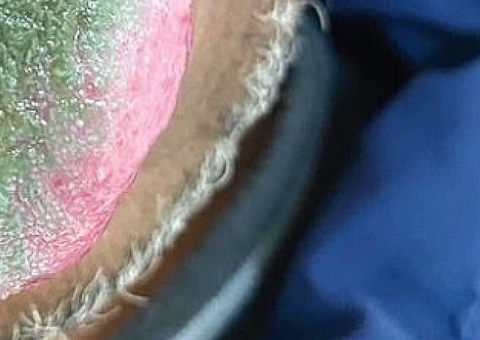 Caso raro de ‘língua peluda’ verde é identificado; entenda causas