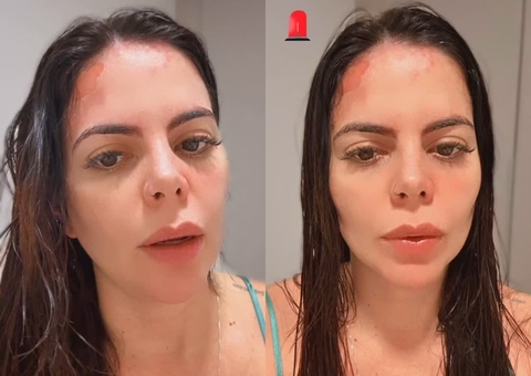 Grávida, ex-Casamento às Cegas sofre queimaduras após panela de pressão explodir