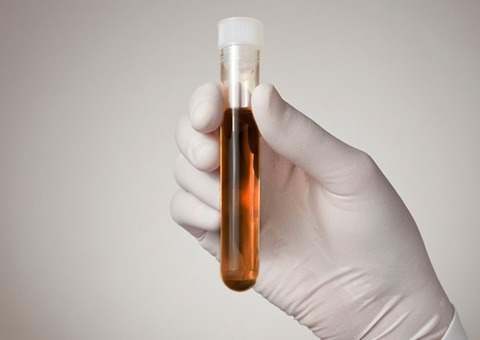 Prefeitura pede cuidado com consumo de peixe durante surto de rabdomiólise no Amazonas