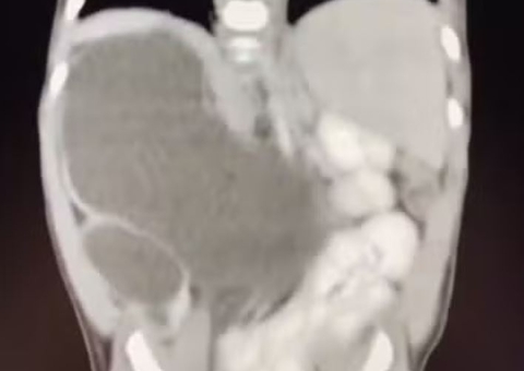 Bebê nasce com quatro rins no Brasil; condição é raríssima 