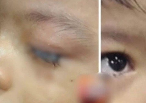 Criança de 2 anos tem olhos colados no Amazonas