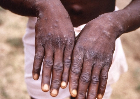 FVS monitora dois casos suspeitos de varíola dos macacos além dos confirmados no Amazonas