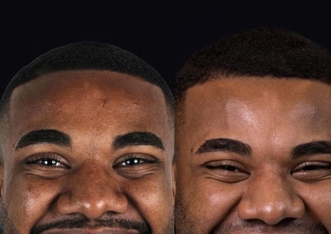 Ex-BBB Davi Brito investe R$ 60 mil em lentes de porcelana e muda o sorriso