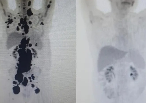 Novo exame aponta que paciente que tratou câncer com terapia continua em remissão