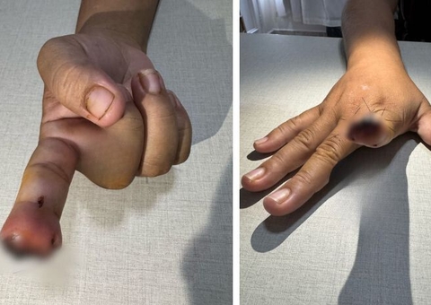 Homem arranca dedo da namorada com mordida em Manaus