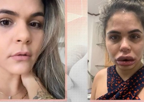 Dentista é acusada de deformar mais de 40 mulheres com harmonização facial