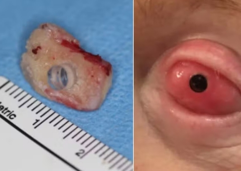 Médico implanta dente no olho para restaurar visão de paciente