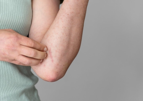 Especialista dá dicas para amenizar efeitos da dermatite atópica