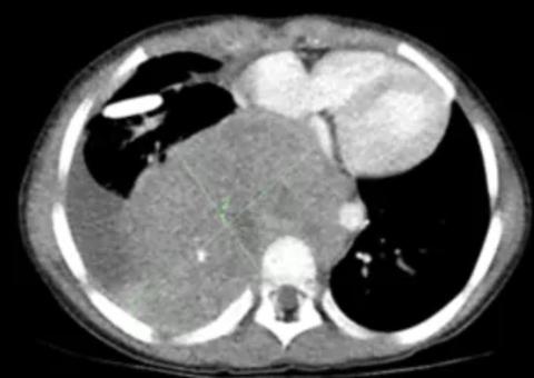Neuroblastoma: farmacêutica submete remédio à aprovação do SUS