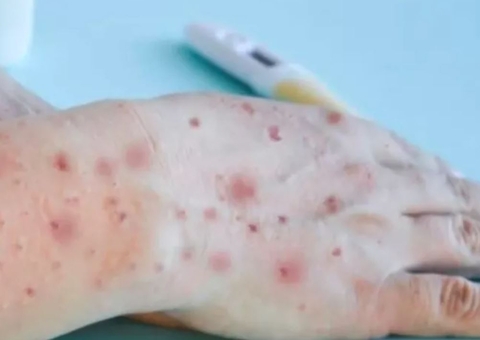 Com 4 novos casos de varíola dos macacos, total de infectados chega a 75 no Amazonas