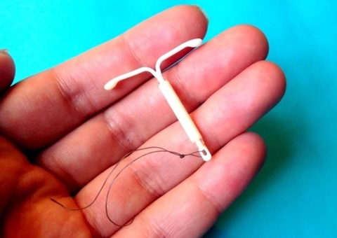 Especialista revela 4 mitos sobre contraceptivos de longa duração