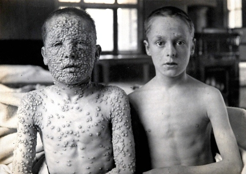 Foto chocante de irmãos com e sem varíola mostra importância da vacinação