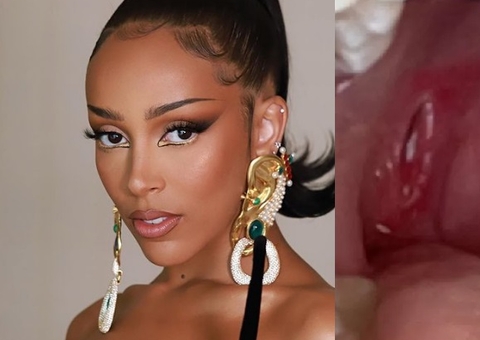 Doja Cat faz cirurgia de emergência após uso de cigarro eletrônico