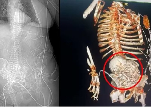 Médicos descobrem “bebê de pedra” calcificado no abdômen de idosa há 56 anos