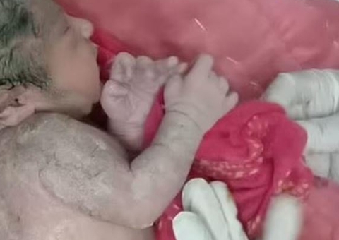 Bebê nasce com terceira mão nas costas e surpreende médicos