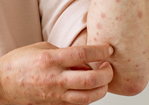 Norte fica em alerta após Rondônia confirmar quatro casos de Mpox 