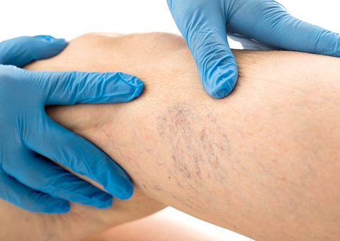 Tratamento de varizes sem acompanhamento médico pode levar à morte