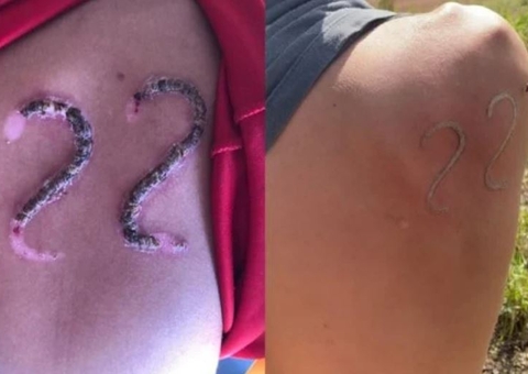 Com ferro de marcar gado, adolescente queima as costas para tatuar número de Bolsonaro