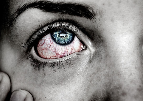 Conjuntivite e amigdalite: Saiba os sintomas poucos conhecidos da Variola dos Macacos