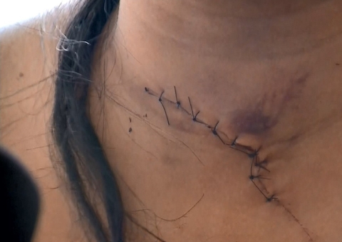 Idosa leva facada no pescoço e marido de 80 anos fica ferido em assalto dentro de casa