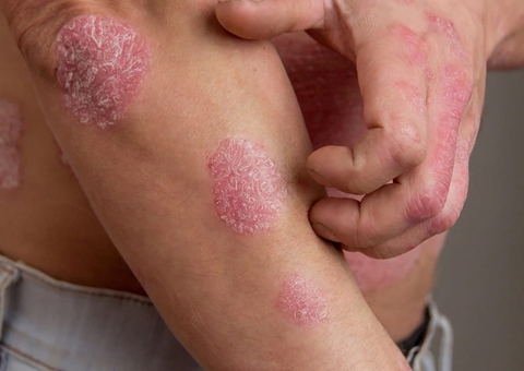 Saiba como identificar e iniciar tratamento da psoríase