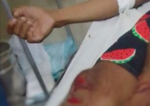 Perna de homem é dilacerada ao ficar presa em roda de moto em movimento no Amazonas