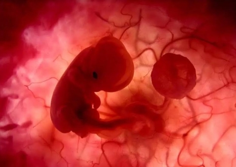 Bebê nasce com feto 'gêmeo' dentro do estômago em Israel; entenda como acontece