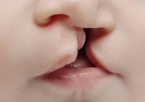 Mutirão de cirurgias de fissura labiopalatal tem agendamento até setembro em Manaus