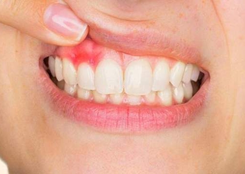 Sexo oral sem camisinha também causa câncer de cabeça e pescoço