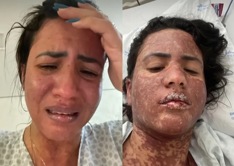 Mulher de Frank Aguiar é internada na UTI com doença rara que queima a pele