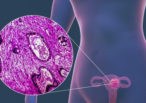 Deputados vão analisar PL que prevê exame genético para diagnóstico de HPV 