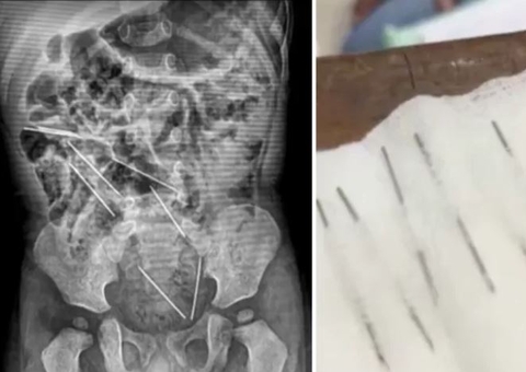 Menino de 2 anos tem 8 agulhas retiradas do estômago