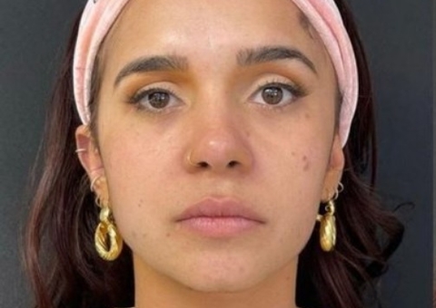 Ex-BBB Gizelly Bicalho faz harmonização facial; veja o resultado