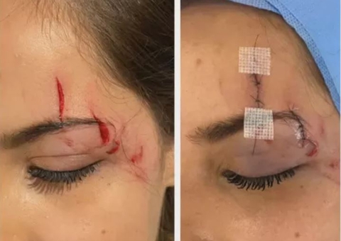 Veterinária passa por cirurgia após ser atingida por drone de banda durante show