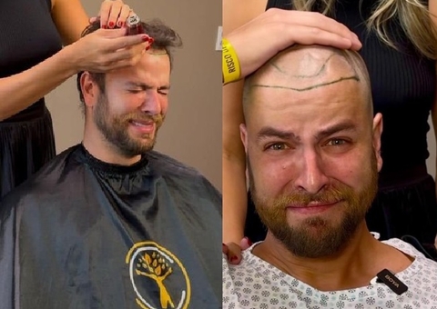 Ex-BBB Gustavo Marsengo faz transplante capilar com pelos pubianos
