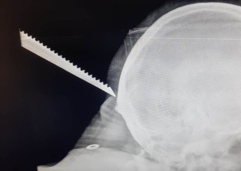 Pedreiro fica com serra cravada na nuca durante acidente em obra