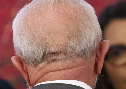 Lula deve permanecer em São Paulo após passar por cirurgia na cabeça