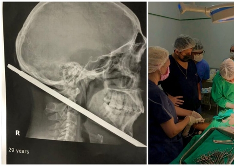 Homem sai para caçar e fica com ferro atravessado no pescoço