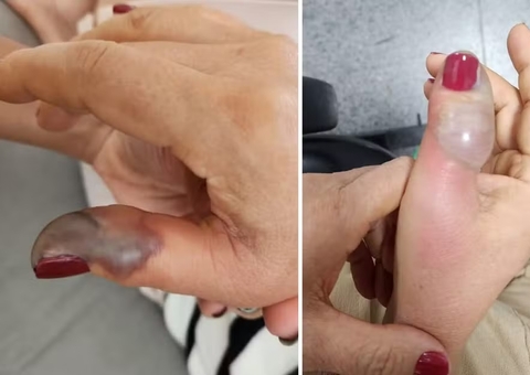 Infecção após manicure leva mulher a perder parte do dedo em SP
