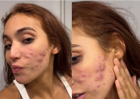 Vanessa Lopes mostra rosto cheio de espinhas e desabafa: “Não aguento mais”