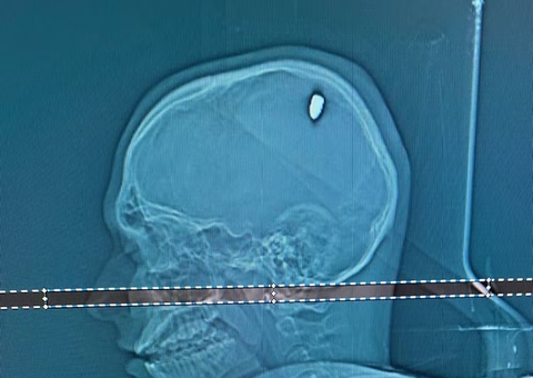 Estudante leva tiro na cabeça e só descobre 4 dias depois: ‘achei que era pedrada’