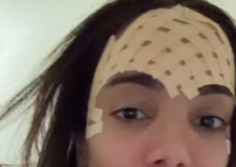 Anitta passa por procedimento para retirar veia saltada da testa 