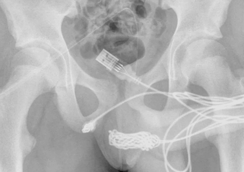 Jovem tenta medir tamanho do pênis e acaba com cabo na uretra