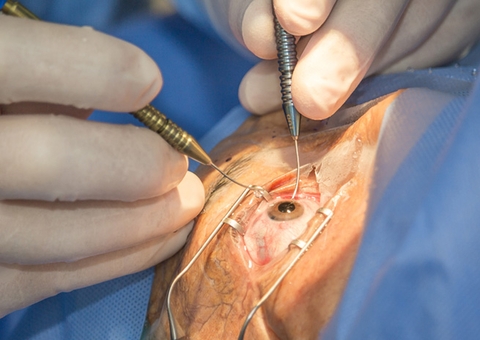 Instituto recorre de condenação por erro em cirurgia de catarata no Amazonas