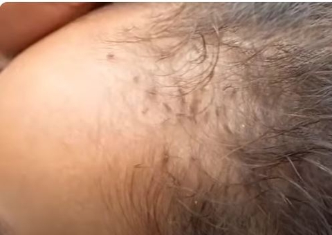 Salão de beleza é condenado a pagar R$ 3 mil por infestar cliente com piolho