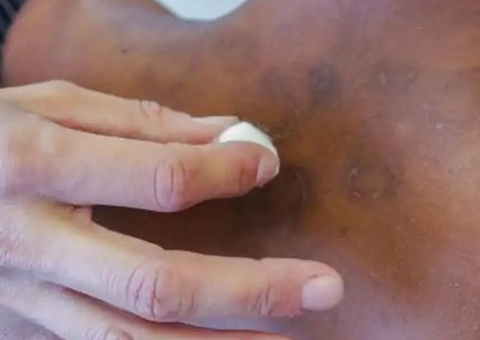 Filhos de isolados por hanseníase no passado vão receber pensão