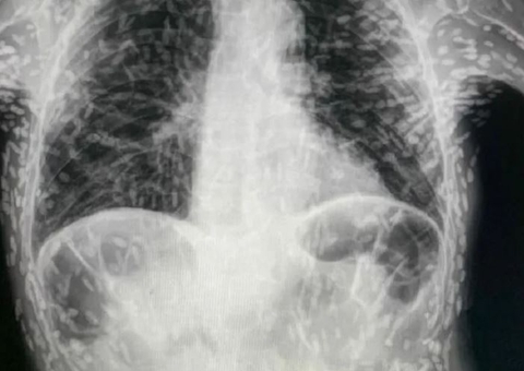 Raio-x de paciente com tosse persistente mostra tórax cheio de ovos de tênia